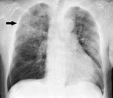 pneumonia x-ray